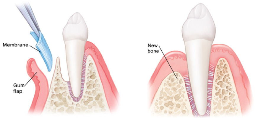 regeneration implants periodontics instead